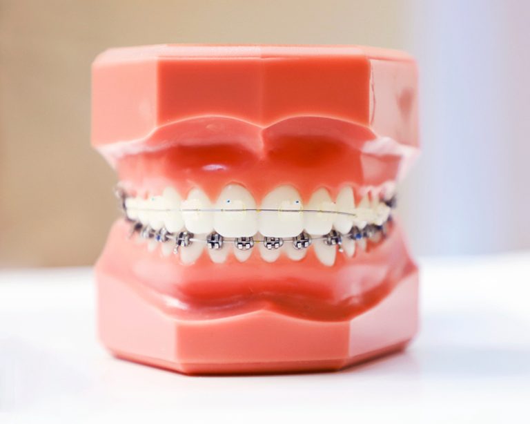 Metal Braces vs. Clear Ceramic Braces | Carmel Orthodontists