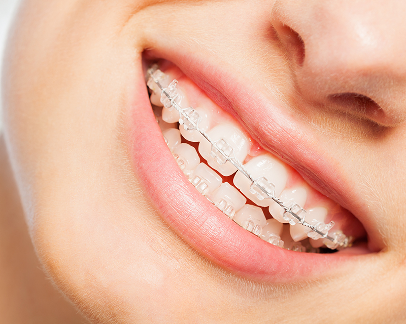 What to Know Before Getting Clear Ceramic Braces