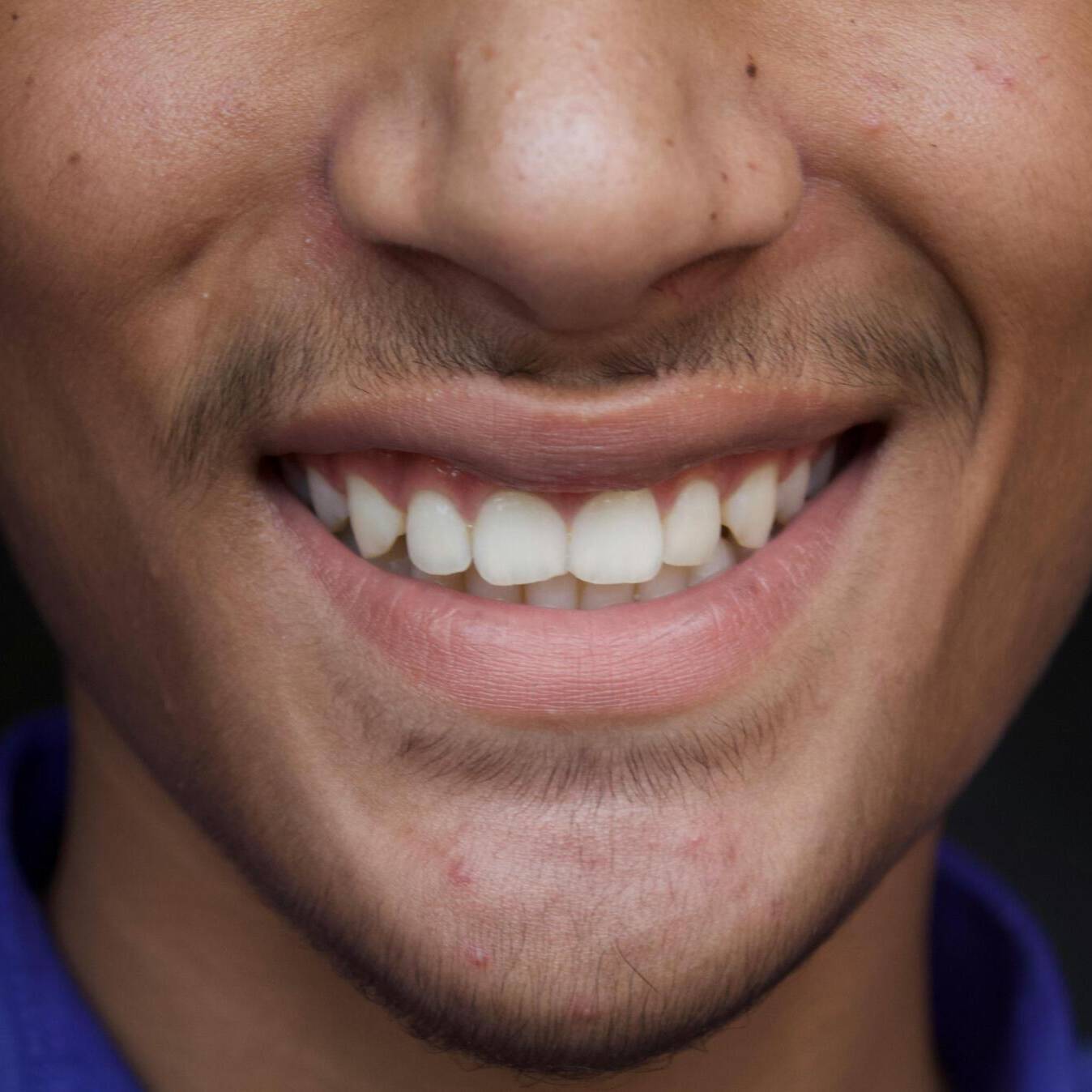 invisalign in Carmel