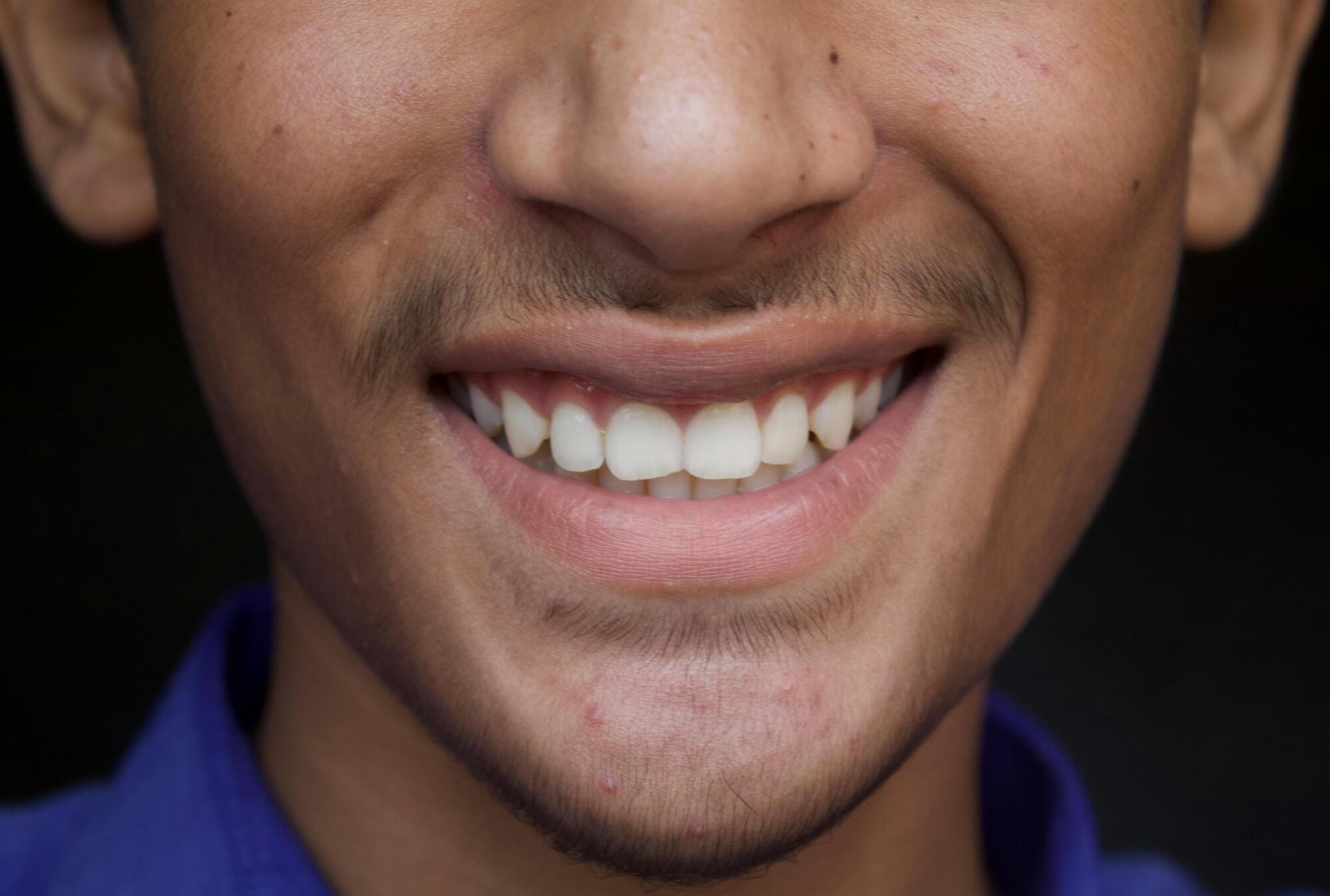 invisalign in Carmel